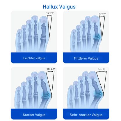 BallenWeg Pro – Sanfte Korrektur bei Hallux Valgus